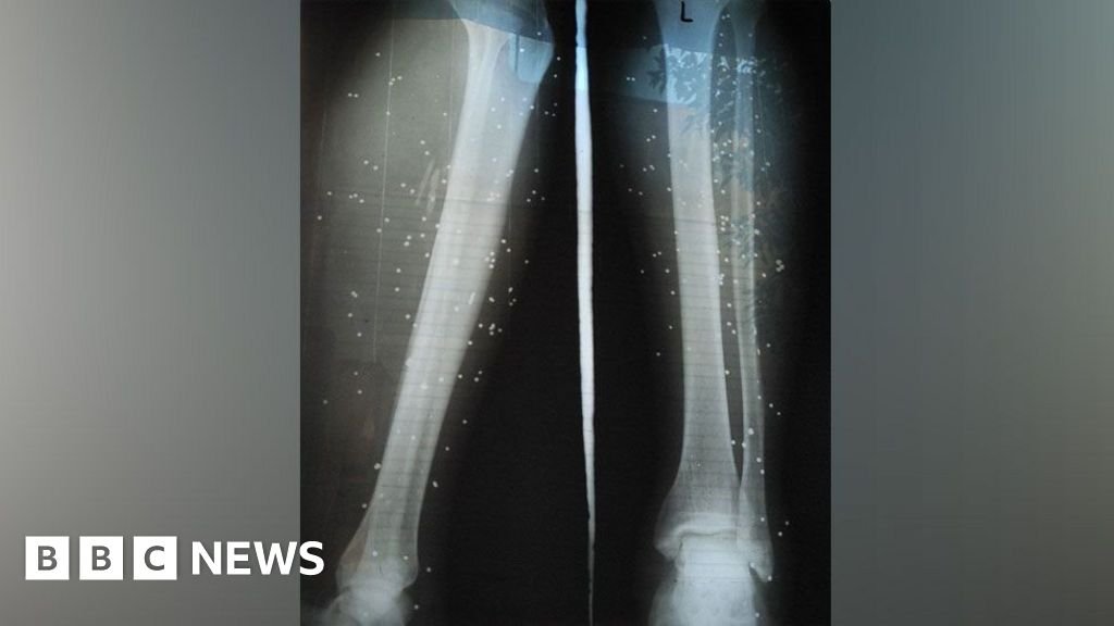 Iran protesters treated in secret to avoid arrest